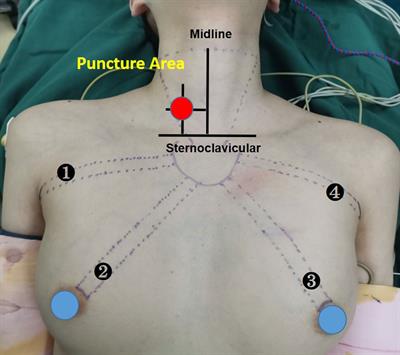 Clinical Experience of Use of Percutaneous Continuous Nervemonitoring in Robotic Bilateral Axillo-Breast Thyroid Surgery